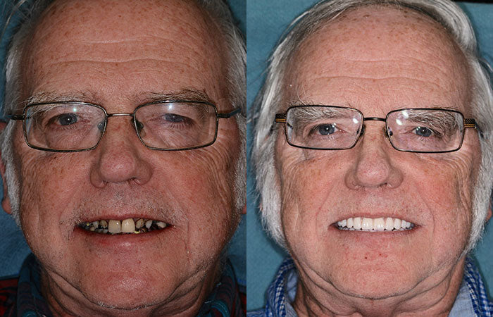 --š¦·Advanced Customized Full Denture Set𦷠{Developed by Harvard University}