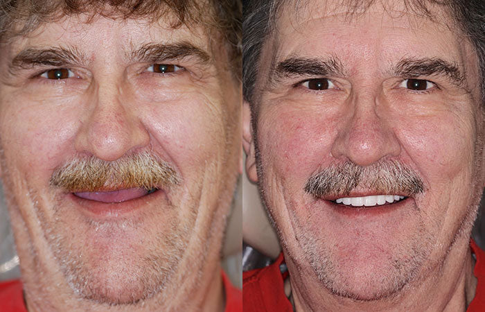 --š¦·Advanced Customized Full Denture Set𦷠{Developed by Harvard University}