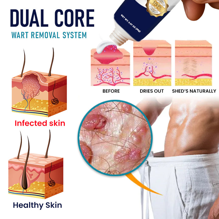 Genital Warts Remover Cream đ¨Designed for Men
