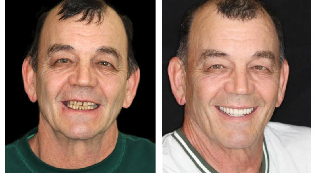 --š¦·Advanced Customized Full Denture Set𦷠{Developed by Harvard University}