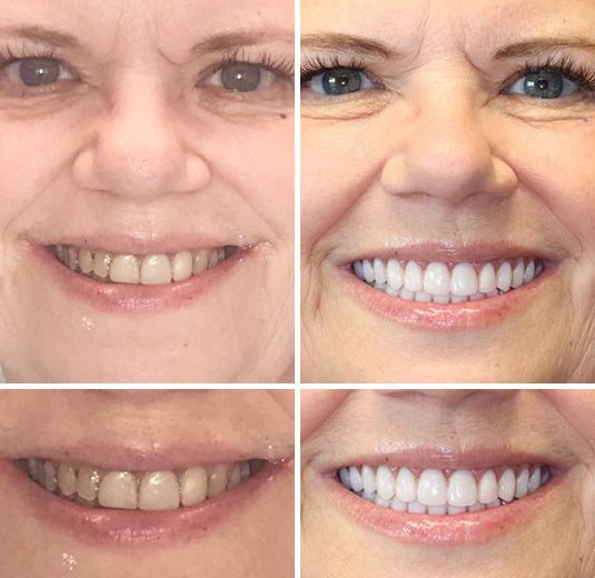 --š¦·Advanced Customized Full Denture Set𦷠{Developed by Harvard University}