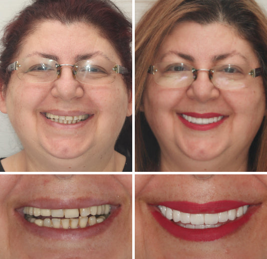 --š¦·Advanced Customized Full Denture Set𦷠{Developed by Harvard University}