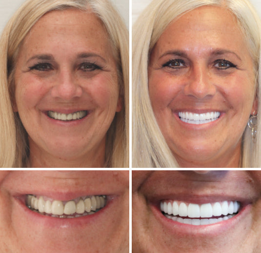 --š¦·Advanced Customized Full Denture Set𦷠{Developed by Harvard University}