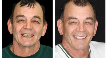 --🦷Advanced Customized Full Denture Set🦷 {Developed by Harvard University}