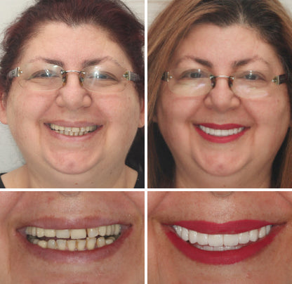 --🦷Advanced Customized Full Denture Set🦷 {Developed by Harvard University}
