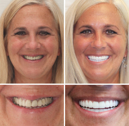 --🦷Advanced Customized Full Denture Set🦷 {Developed by Harvard University}